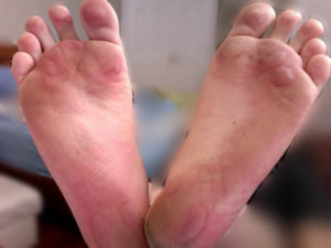 blisters