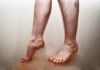 how nurses can prevent varicose veins