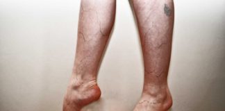 how nurses can prevent varicose veins